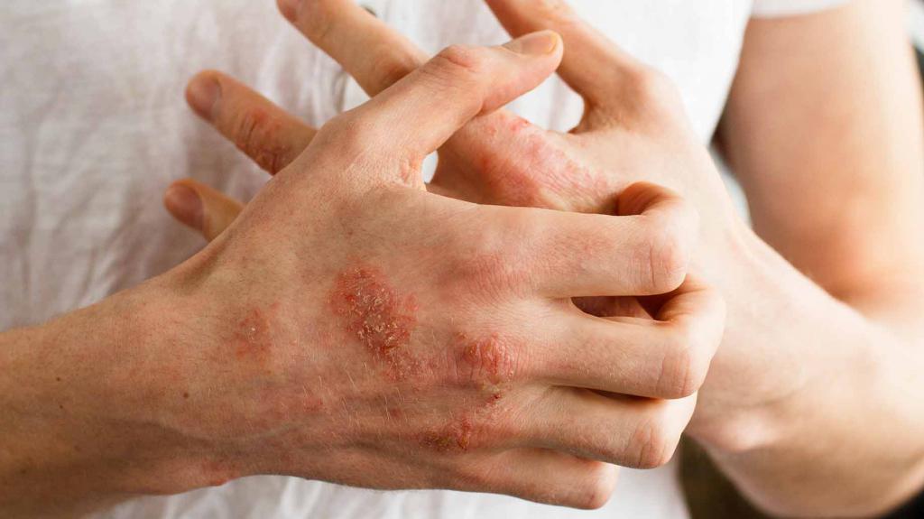 Дали псориазисът на кожата е заразен?