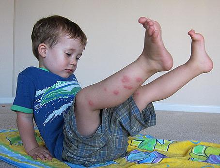 Детето беше ухапан от комари: какво да правим?